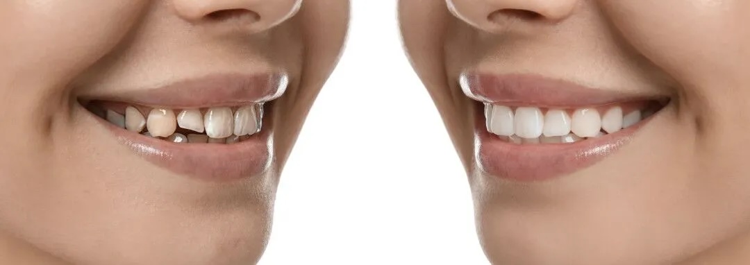 Veneers