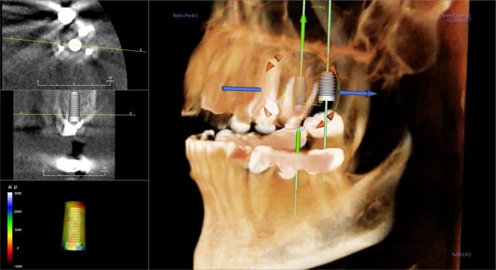 CT Scan