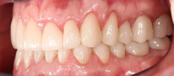 TMD Treatment