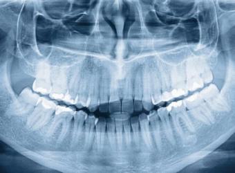 What do we see in dental radiographs?